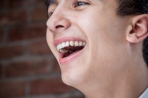 Lingual-or-Incognito-Braces